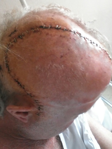 Tom's head after surgery